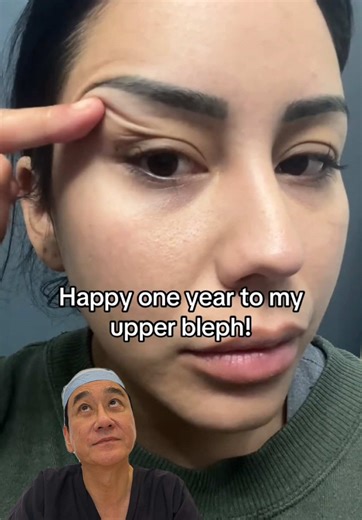 Absolutely love her results! Angles, makeup, and filters could be the reason for the overall result but an upper blepharoplasty only treats eyelid skin, it doesn’t lift the brows or smooth nasolabial folds. For that level of lift, an endoscopic midface temple lift is recommended to deliver this kind of result. VC: @Maleni