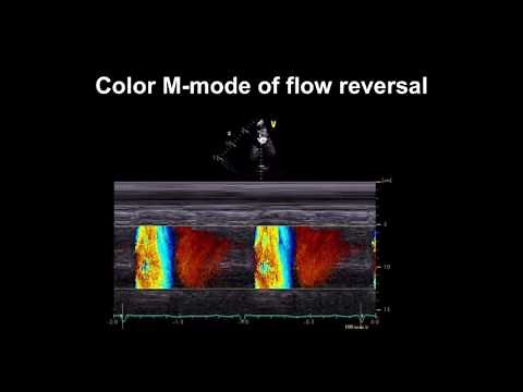 Echocardiography Essentials: Detecting aortic regurgitation