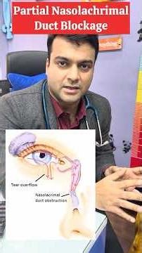 Tear duct blockage in babies #BlockedTearDuct #NasolacrimalDuct #BabyEyeCare #NewbornCare #parenting
