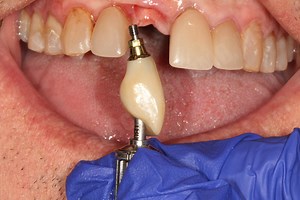 Angled Screw Channel - A Paradigm Shift in Implantology?