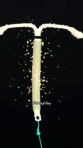 Intrauterine Device (IUDs) For Birth Control #drone #theflash #space #automobile #scifi #doctor