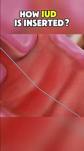 How IUD is inserted?|3D ANIMATIONS|#IUDInsertion#medicalprocedures #cervicalhealth #fyp