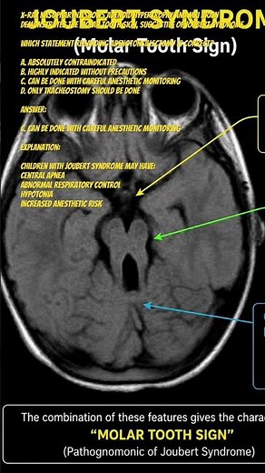 JOUBERT SYNDROME