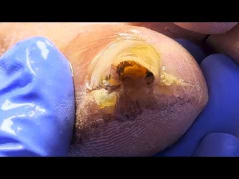 Super Curly Yellow Nails That Grow Crazily Into The Flesh【Doctor Liu's Pedicure】