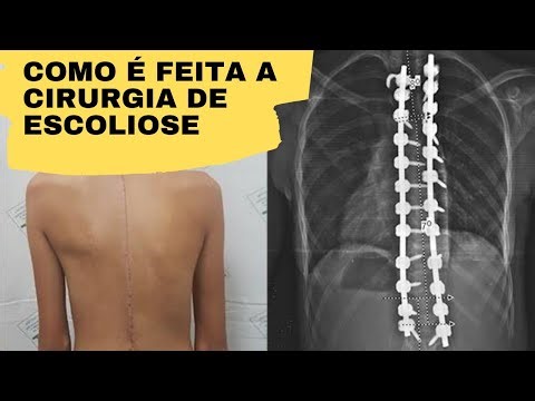 Veja como é feito a escoliose | Como corrigir a coluna vertebral | Medicina Geral