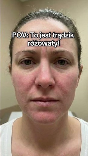 Co wycisza trądzik różowaty? #shorts