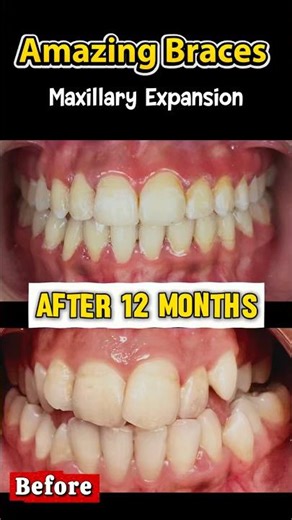 12-Month Braces Expansion 😳 Before → After