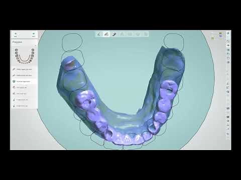 How to use Straumann® RevEX™ scans in 3Shape Dental Designer