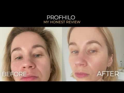 Profhilo at 40: Honest Review After Face, Neck & Knees