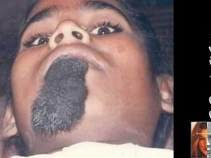 15 Congenital pigmented or melanocytic nevus Hairy Nevus Chin