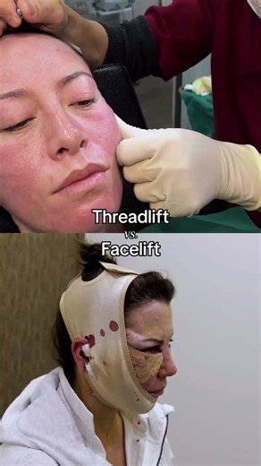 Thread Lift vs Facelift 🤔✨