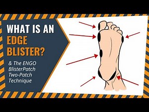 What Is An Edge Blister & The ENGO Blister Patch Two-Patch Technique
