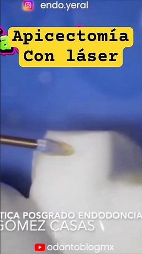 Laser apicoectomy #laser #laserendodontics #dentistry #apicoectomy #endodontics