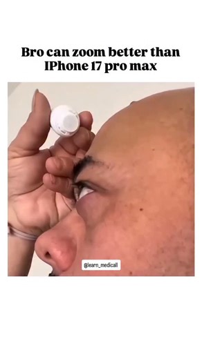 medicos_world | This man in the reel has a very rare and interesting medical condition, likely related to his thyroid, given the prominent exophthalmos, a... | Instagram