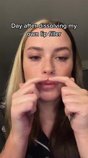 Dissolving Lip Filler Transformation: Day 1 After 5 Years
