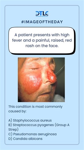 DocTutorials Learning Centre on Instagram: "#imageoftheday 👉A patient presents with high fever and a painful, raised, red rash on the face. 💬 Drop your Answer in the comments.👇 A) Staphylococcus aureus B) Streptococcus pyogenes (Group A Strep) C) Pseudomonas aeruginosa D) Candida albicans #ImageOfTheDay#ClinicalSign#FacialRash#ErysipelasSkinInfectionBacterialInfectionStreptococcusPyogenesGroupAStrepDermatologyInfectiousDiseasesMicrobiologyMedicineInternalMedicineClinicalDiag"