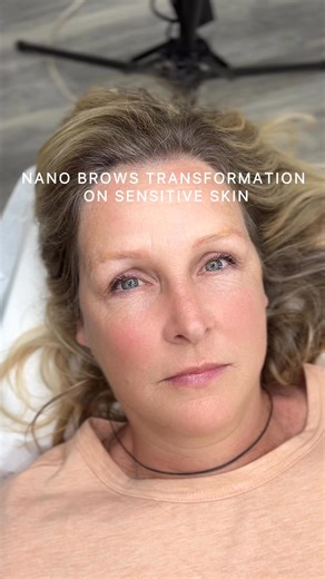 She had her brows microbladed 8 years ago (not by us) and decided to laser them off for a fresh start with Nano Brows. Because her skin is very sensitive and delicate, I used just the right pressure to keep the color in while avoiding bleeding so the strokes heal crisp and natural. If you have oily skin and want a soft, natural look, Nano Brows are a great option. And if you’re looking for thin, airy strokes, that’s our specialty. | Be Brows