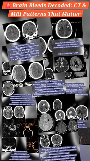 Adeel Ur Rehman | 🧠 Know the Bleed: Patterns of Intracranial Hemorrhage Not all brain bleeds are the same. Location, shape, and imaging appearance can tell... | Instagram