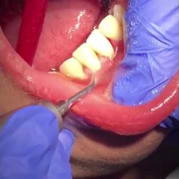 Scaling teeth with ultrasonic scaler