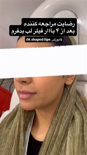 ‎دکتر سپیده صفری/‌پزشک فعال در زیبایی و درمان‎ on Instagram‎: "کپشن مهم… در تزریق این نوع فیلر لب حتما در نوع فن زدن هاتون و عمق تزریقتون باید دقت کنید نه آسیبی به عروق و عضله بزنید و نه سطحی تزریق کنید که ناموثر باشه.برخلاف فرم لبهایی که عموما آموزش داده میشوند توی m_shaped lips ما به صورت نرمال همه ی لب رو فن نمیزنیم بعضی نقاط اصلا تزریق نمیشن و حجم تزریق در بعضی نقاط متفاوته،حتی سطح تزریق در دو سطح کاملا مختلف صورت میگیره. اگر لبهایی به این فرم دارید حتما به پزشکی مراجعه کنید که بارها تجربه ی