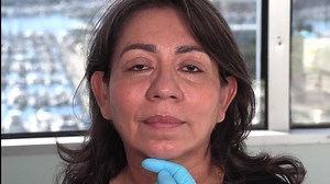 Chin Augmentation   Submental Liposuction