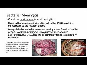 Intro to Microbiology: Microbial Diseases of the Nervous System