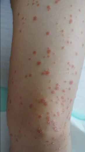 Guttate psoriasis | #psoriasis #skin #psoriasisawareness #psoriasissolution #dermestidscanada #short