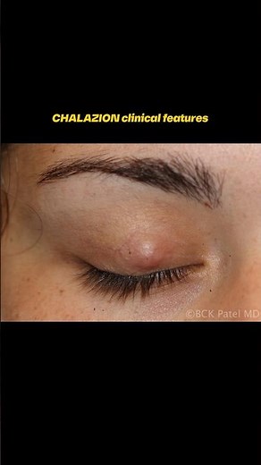 Chalazion Clinical Features & Complications 👁️ | Ophthalmology Quick Revision