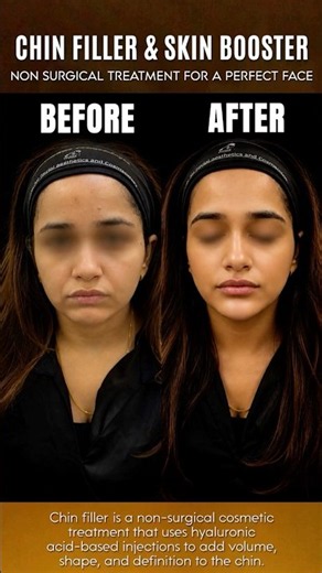 Chin transformation | Define jawline | How to get perfect jawline? #chinfiller