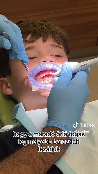 Barázdazárás: Védje meg gyermeke mosolyát!