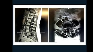 OLIF for Spinal Fusion - Live Spine Surgery - Live Brain and Spine Surgery