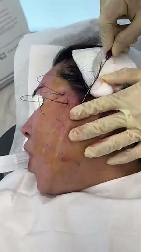 Miracu PDO thread Face Lift Treatment by Dr. Tsay - Ageless MD