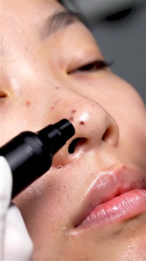 Ultimate Blackhead Vacuum Extraction for Deep Cleaning