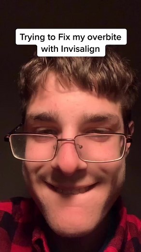 Fixing Overbite with Invisalign - Success Story