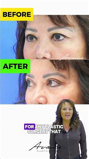 Patient Tina's Blepharoplasty Before and After | Avance Plastic Surgery Institute: Dr. Erez Dayan