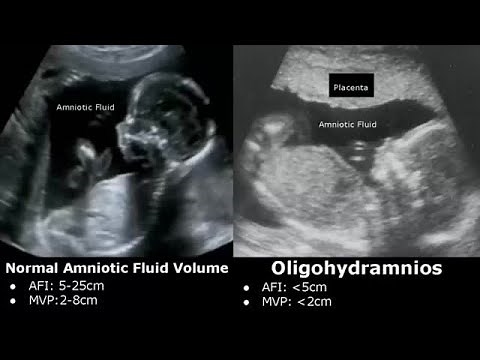 Obstetric Ultrasound Normal Vs Abnormal Images | Fetal, Placenta, Umbilical Cord Pathologies USG