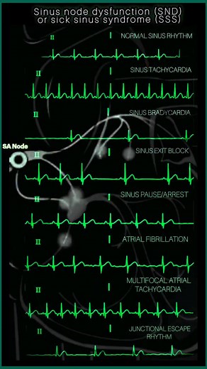 Sick Sinus Syndrome (SSS), or sinus node dysfunction (SND) ⚡This ECG visual highlights SSS-related rhythms: Sinus Bradycardia/Tachycardia, Sinus Pauses/Arrest, Exit Blocks, AFib, MAT, Junctional Escape, and more (e.g., AVNRT, AVRT if accessory pathways exist, ectopic atrial rhythms). Tachy-Brady Syndrome is common, with tachyarrhythmias predominating in most patients. Manage with pacemakers for bradyarrhythmias & rate control for tachycardias. #Cardiology #Electrophysiology #SickSinusSyndrome #E