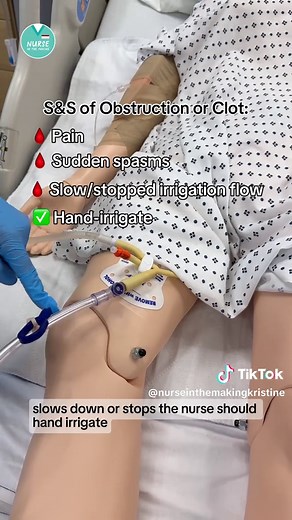 What is Continuous Bladder Irrigation (CBI)?💧 It’s a steady flow of sterile fluid through a catheter to help flush out blood, clots, or debris from the bladder—often used after bladder surgery or Transurethral resection of the prostate (TURP) The goal? Keep the urine light pink and the catheter flowing freely! #CBI #NursingSchool #NursingStudent #BladderIrrigation #ClinicalSkills #NurseInTheMaking