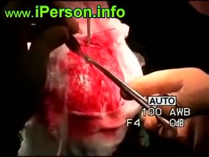 PARASITES TUMORS IN THE HUMAN BRAIN. ECHINACOCCUS PARASITES Surgery To Remove A Tumor From The Brain : PARAMEDIA VIDEO : Free Download, Borrow, and Streaming : Internet Archive