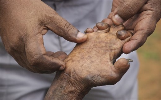 Leprosy Explained: What it is, how it’s treated, and why the stigma must end