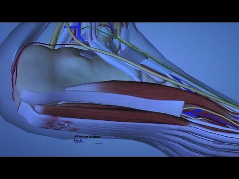 Causes of Plantar Fasciitis