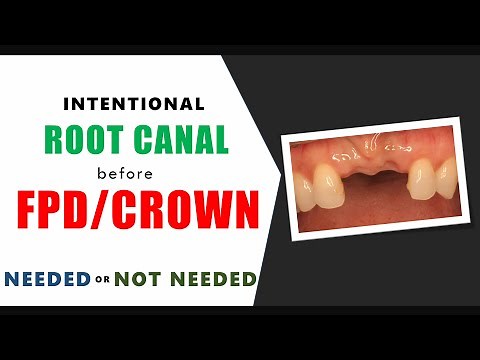 Intentional RCT before Crown/FPD : RIGHT OR WRONG