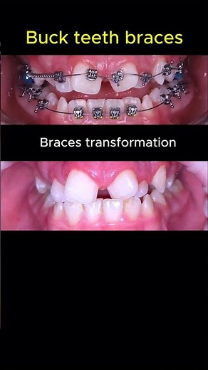 Fix buck teeth with braces. Orthodontist journey #orthodontist #dentist #braces