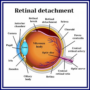 Retinal Tear & Detachment - Retina Vitreous Consultants, Inc