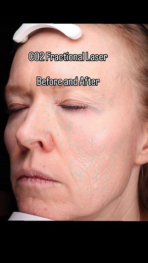 Stunning results 3 months post CO2 ✨️ 🔸️I love the reduction in the lines on her cheeks. Such a great result! Her skin is brighter, healthier, more toned. The blue dots that you can see are indicating 'spots' on her face so vascular and pigmented lesions have also reduced. Results will continue for about 6 months so here's waiting for the 6 month mark. I expect to see further improvements. 🔸️If you would like to find out more information, come in and see me @dermaspa.oakbay. 🗓 I have been wor