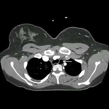 Esophageal Duplication Cyst