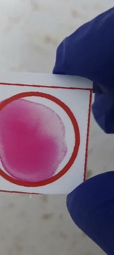 Rose Bengal test (RBT) shows a positive reaction in a rapid slide-type agglutination assay.