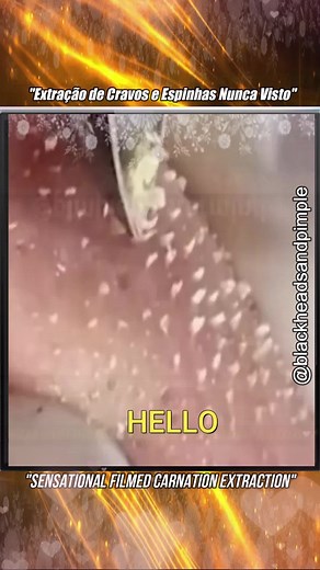 squeezeblackhead no TikTok