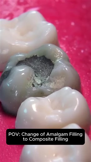 Amalgam Filling Removal and Composite Filling Process