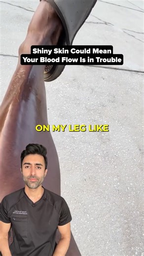 Kunal Sood, MD on Instagram: "A shiny, smooth leg can be normal, but it may also signal reduced blood flow, especially in conditions like PAD. If it’s new or comes with cramping or coldness, talk to your healthcare provider. Have you seen this before? #medical #health #healthtips VC: @ricodaman50grand"